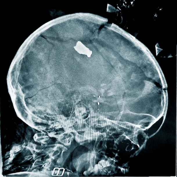 Granaatscherven in het hoofd van een jong meisje.