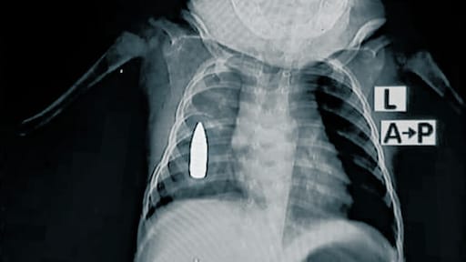 Kogel in borstkas dreumes te zien op röntgenfoto's uit Soedan