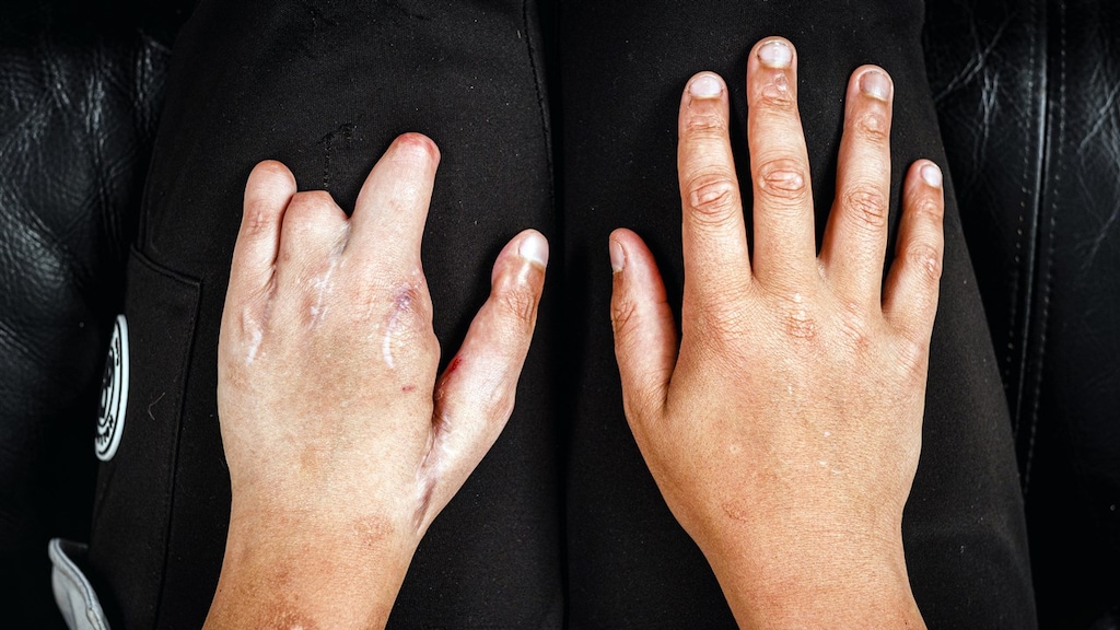 Steeds meer zwaar vuurwerk – en dus ook ergere verwondingen: 'Wat we zien, is verschrikkelijk'