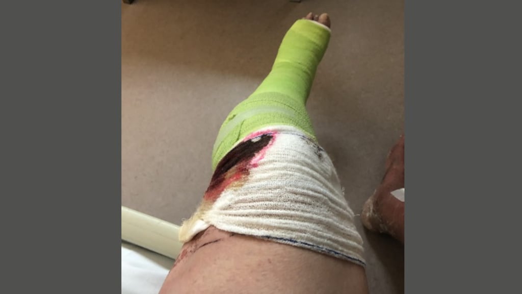 Ignacio had op veel plekken brandwonden opgelopen.