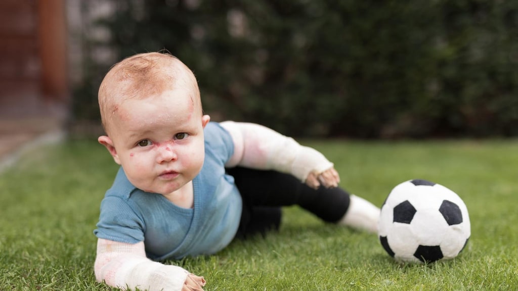 Dax heeft de vlinderziekte al sinds zijn geboorte.