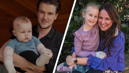 Gezinnen smeken om peperdure zalf voor hun 'vlinderkinderen' Dax (2) en Yade (7): 'Elke dag een marteling'