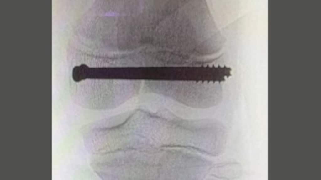 De schroeven in Amirs knie.