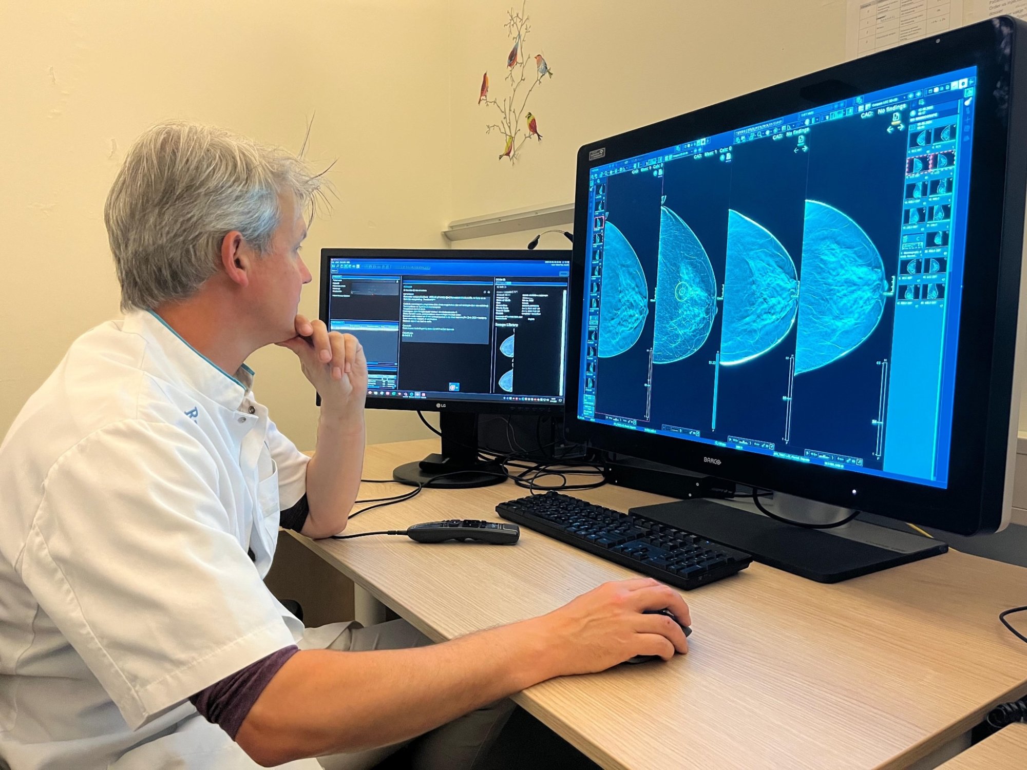 AI kan radioloog vervangen bij borstkankerscreening, blijkt uit Nederlands onderzoek