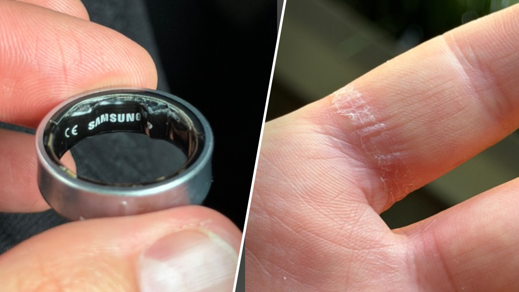 Samsung Ring zwelt op, zit vast aan vinger: man moet naar ziekenhuis