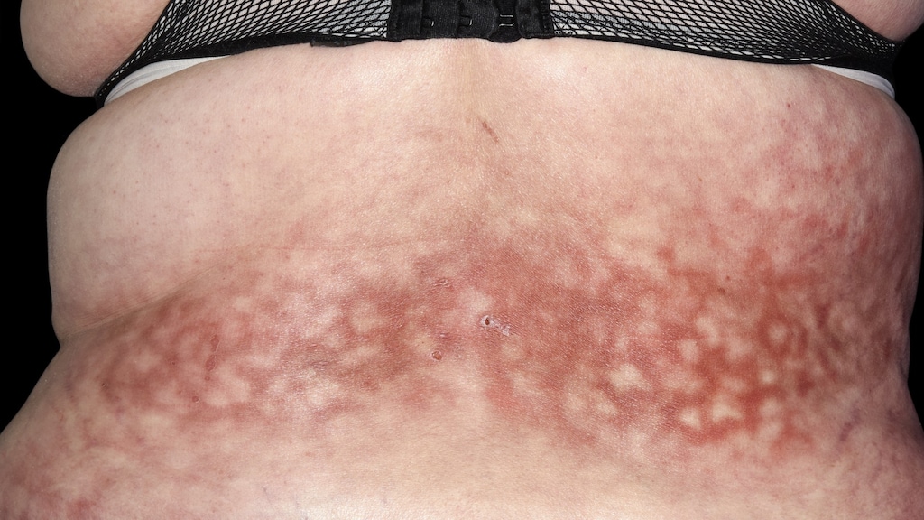 Erythema ab igne.