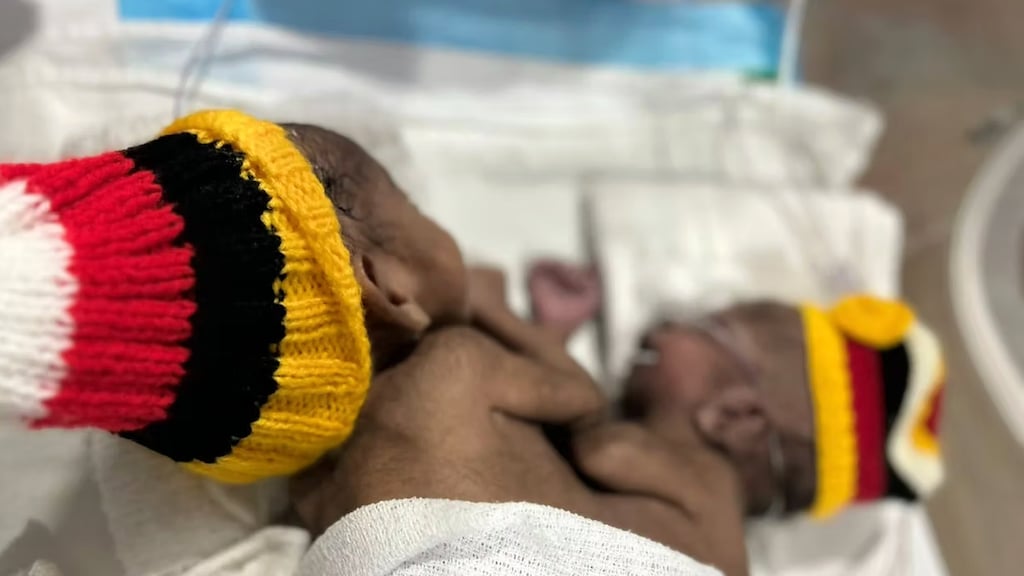 Risicovolle scheiding Siamese tweeling mislukt in Australië: baby Tom ...