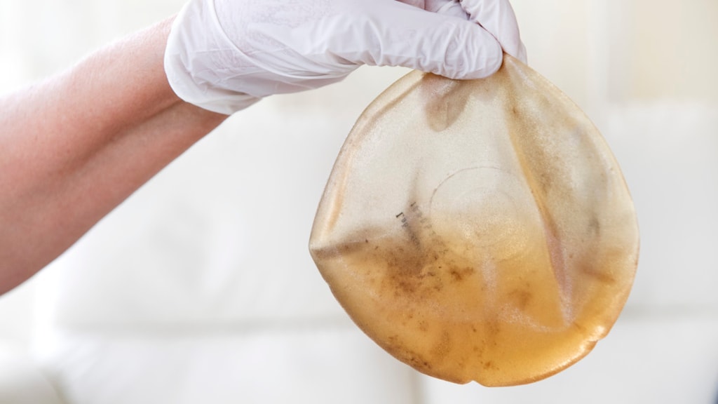 Producent 'gebrekkige' borstimplantaten niet aansprakelijk voor ziektes