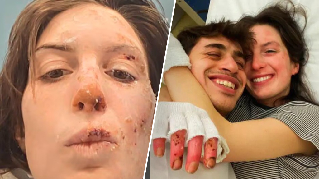 Slachtoffer cafébrand Zwitserland toont brandwonden: 'Denk aan alle engelen'