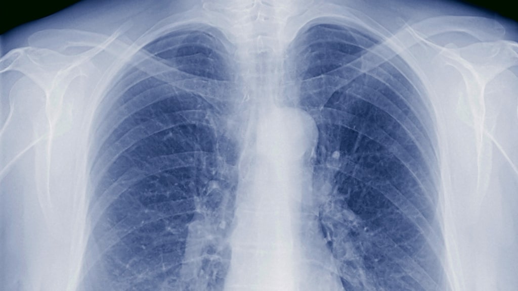 300 mensen onderzocht op tbc na besmetting in Hengelo