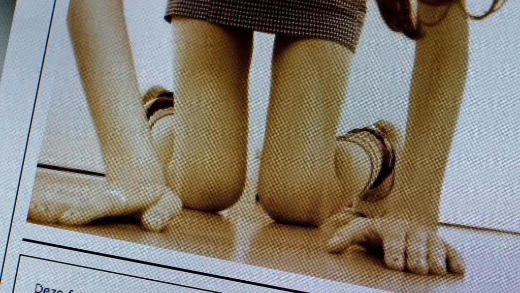 Kinderen krijgen steeds jonger anorexia, nieuwe aanpak vereist