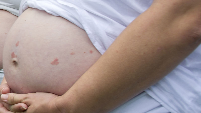 'Vrouwen kiezen ruggenprik om gratis bevalling'