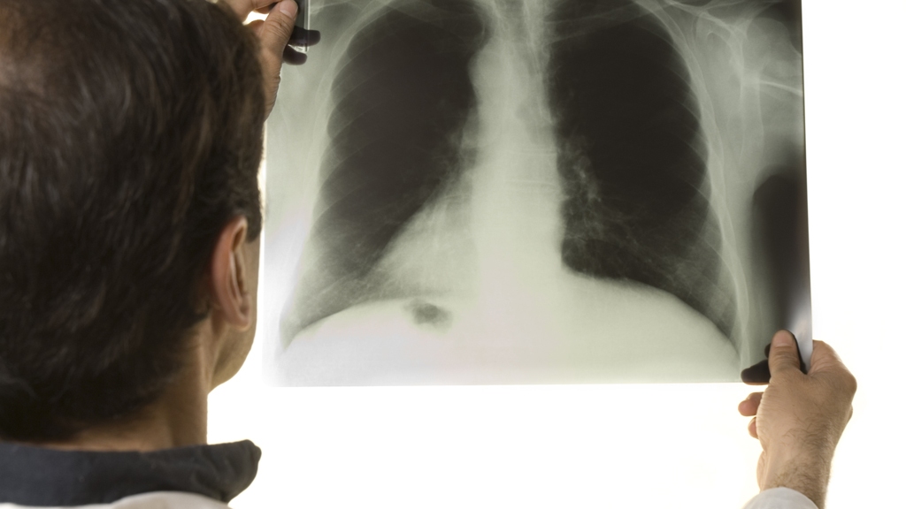 'Hoop op nieuw medicijn tegen tuberculose'