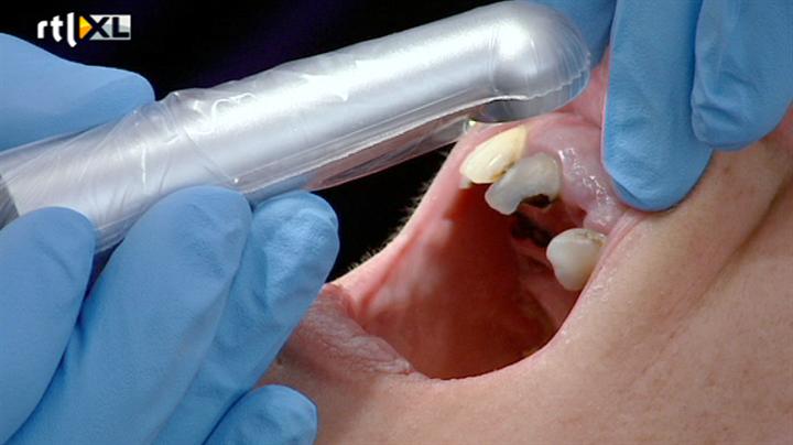 Goed tandenpoetsen kan dementie voorkomen