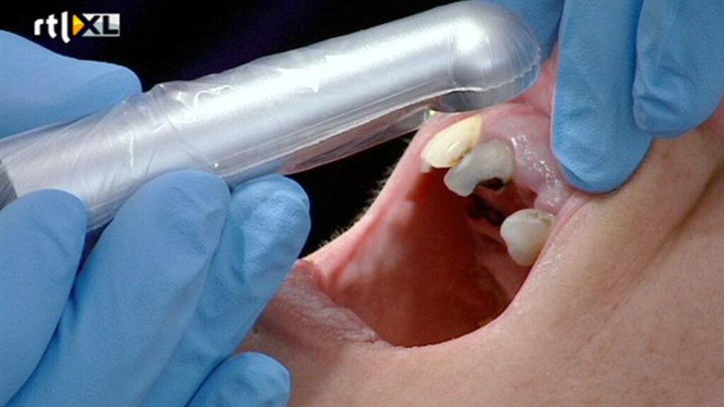 Goed tandenpoetsen kan dementie voorkomen